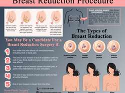 Breast Reduction Procedure