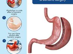 myths-about-alcohol -&-bariatric-surgery