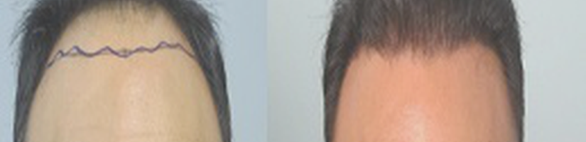 زراعة الشعر في دبي's cover image