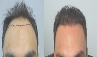 زراعة الشعر في دبي